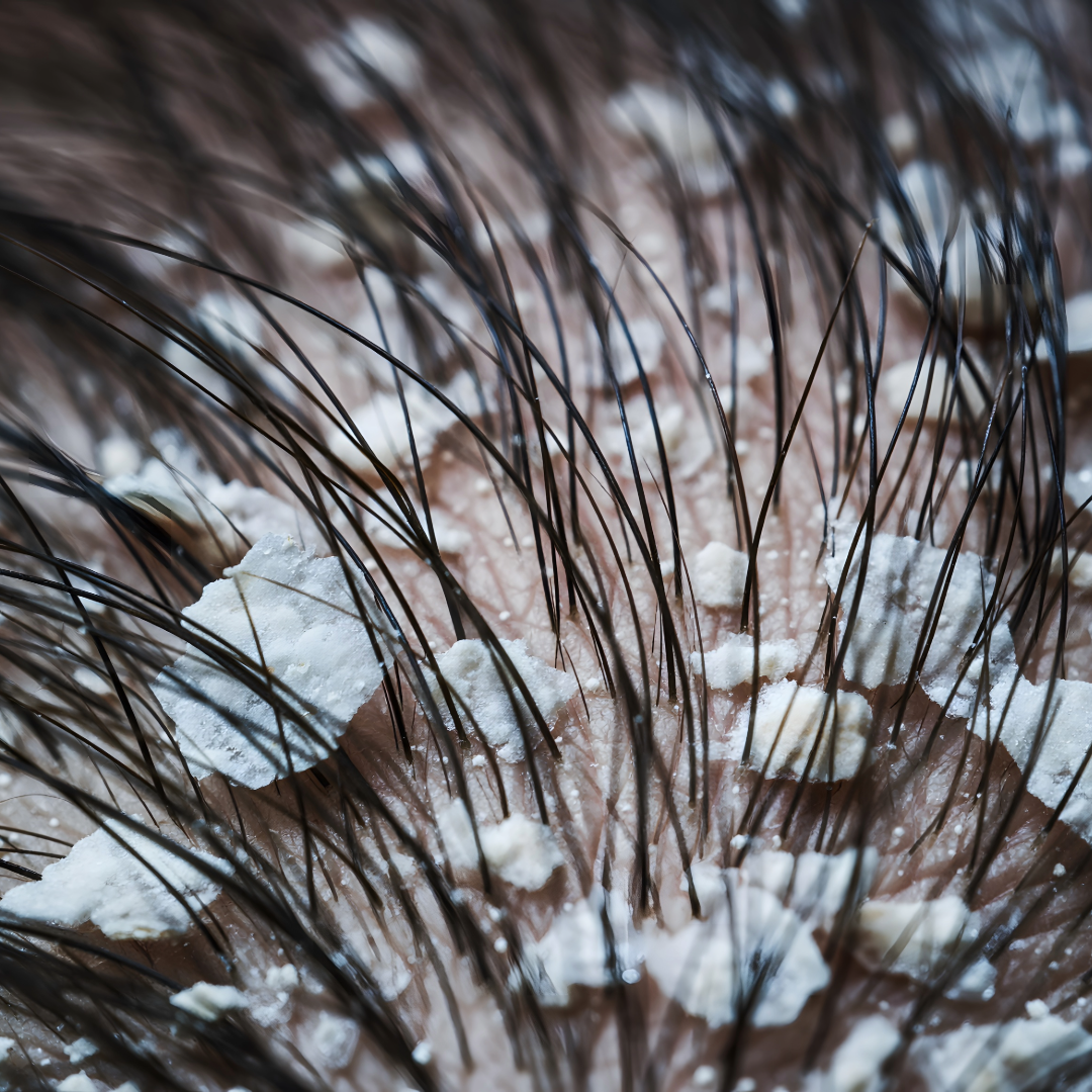 Flaky scalp close-up with dandruff - seborrheic dermatitis and scalp treatment - Wicked Hues New Orleans