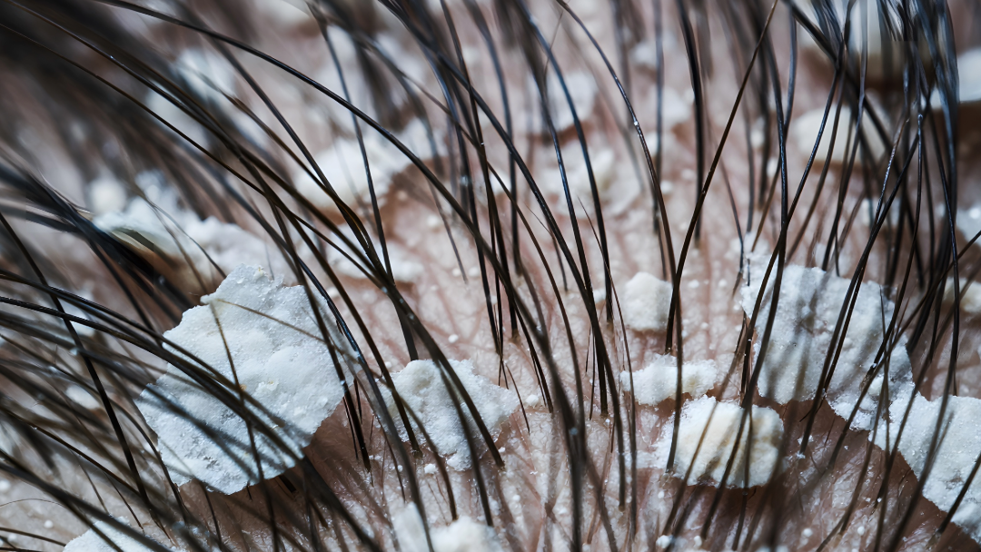 Flaky scalp close-up with dandruff - seborrheic dermatitis and scalp treatment - Wicked Hues New Orleans